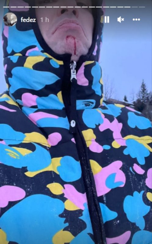 Galleria foto 'Chiara Ferragni e Fedez in vacanza, ma il rapper ha un incidente: “Mi sono aperto la faccia”' - foto 2